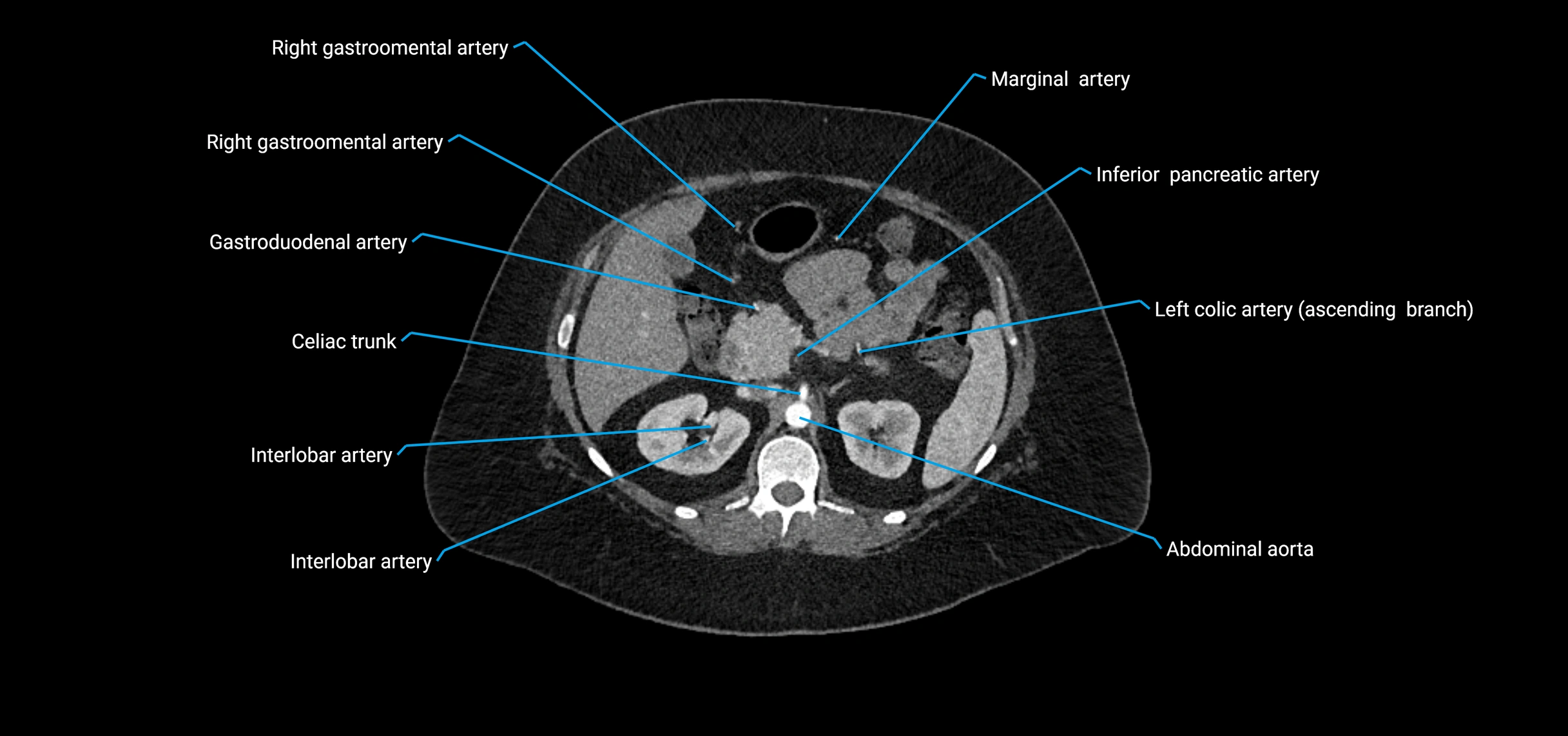 CTA abdomen axial cross sectional anatomy labelled image_63 (2).webp